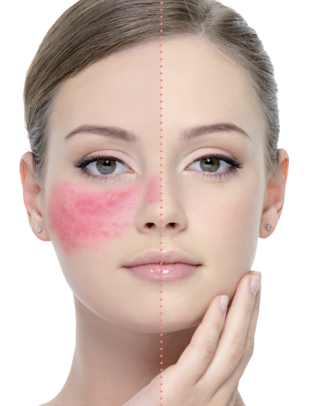 Praktisk Modig Vulkan Rosacea - Best makeup tips - The Skin Care Clinic