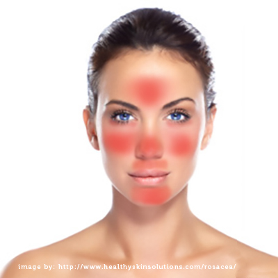 Praktisk Modig Vulkan Rosacea - Best makeup tips - The Skin Care Clinic