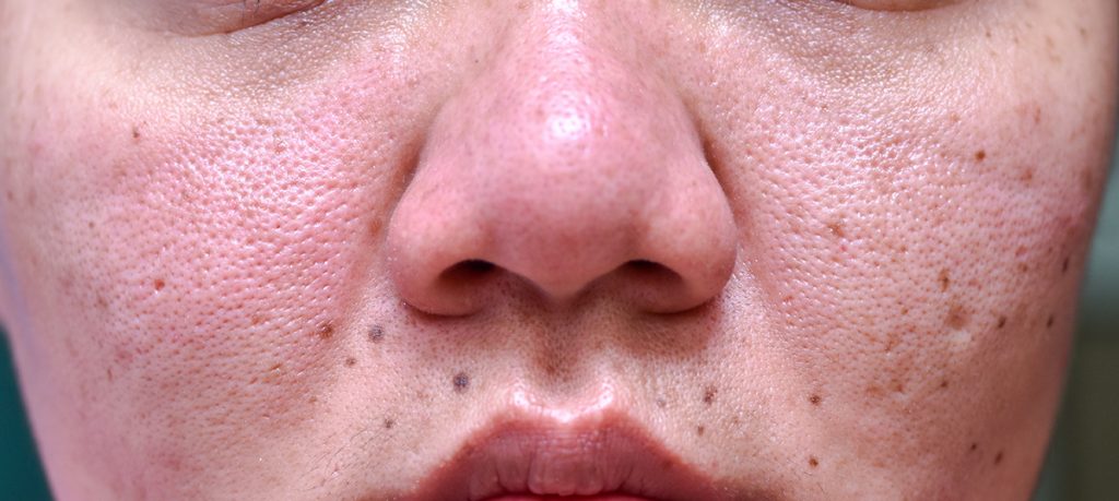 Enlarged Pores Tips