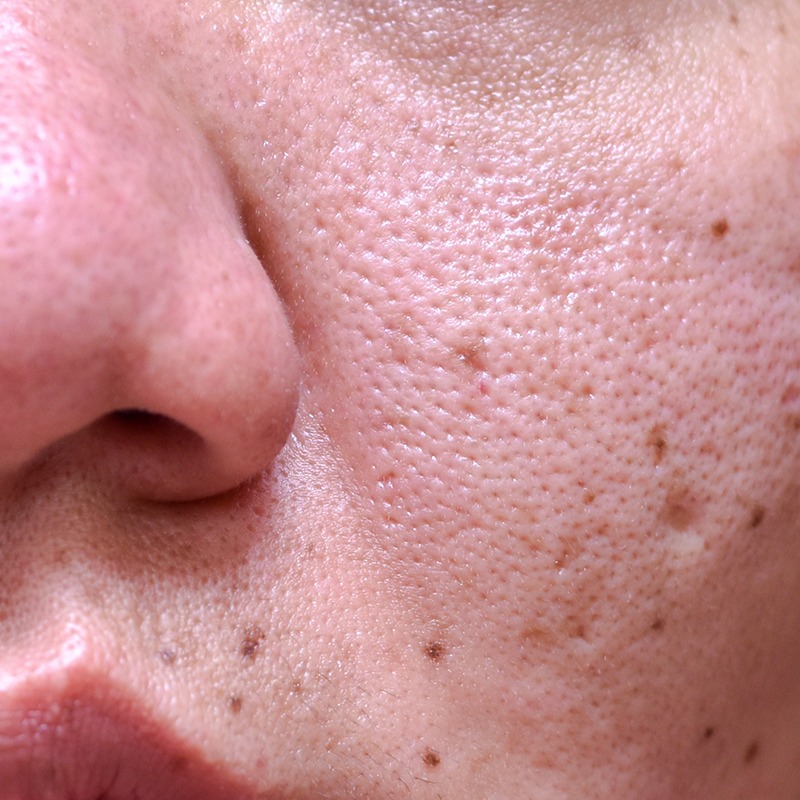 What Causes Large Pores and How Do I Treat Them?