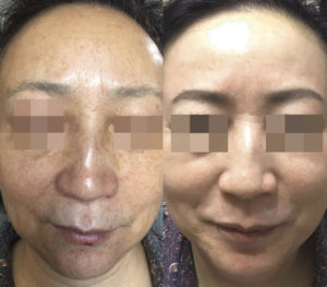 Cosmelan Depigmenting Treatment Before After