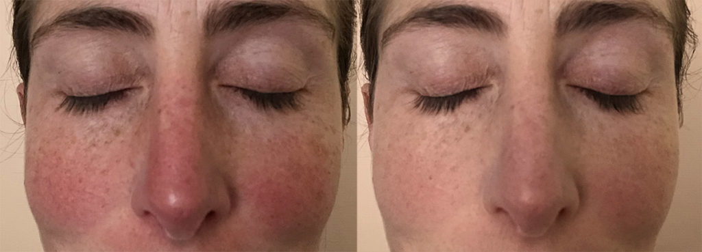 Colorescience All Calm Comparison Before After