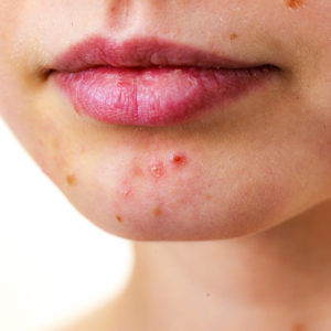 Best Skin Tips Acne