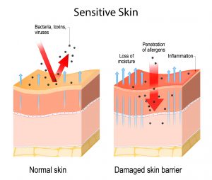 sensitive and reactive skin diagram