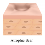 Atrophic Scar