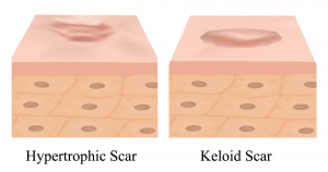 Hypertrophic & Keloid Scar