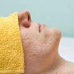 Acne Scarring Treatments