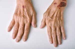 Senile Purpura Elderly Skincare