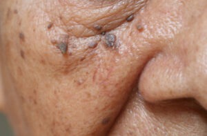 Skin Tags Elderly Skincare