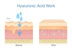 Skin Diagram Hyaluronic Acid Work
