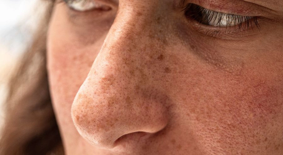 Your Pigmentation Routine Before Spring: The Window Most Clients Miss